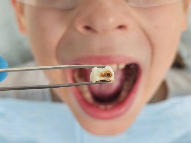Best Cracked Tooth Emergency Dentist  in Mountainside, NJ